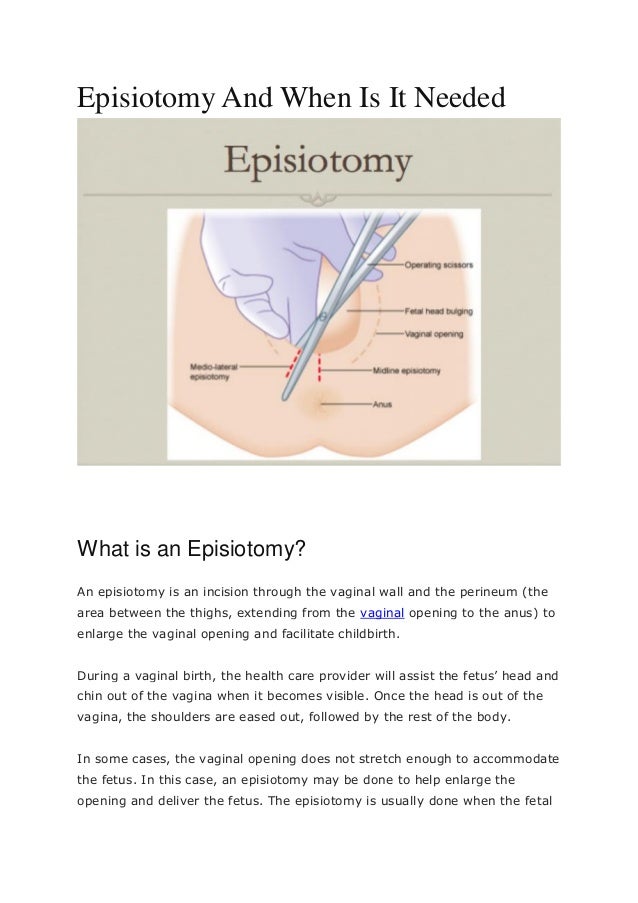 Episiotomy And When Is It Needed Pdf