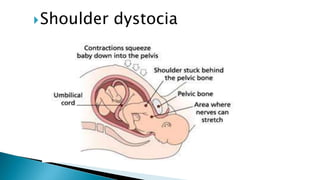 Shoulder dystocia
 