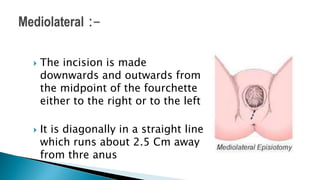  The incision is made
downwards and outwards from
the midpoint of the fourchette
either to the right or to the left
 It is diagonally in a straight line
which runs about 2.5 Cm away
from thre anus
 