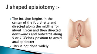  The incision begins in the
center of the fourchette and
directed along the midline for
about 1.5cm and then directed
downwards and outwards along
5 or 7 O’clock position to avoid
anal sphincter
 This is not done widely
 