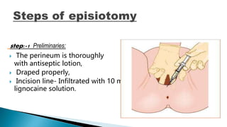step:-1 Preliminaries:
 The perineum is thoroughly
with antiseptic lotion,
 Draped properly,
 Incision line- Infiltrated with 10 ml
lignocaine solution.
 