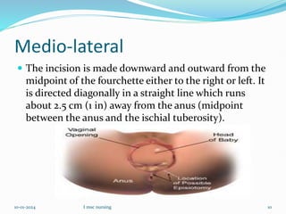 Medio-lateral
 The incision is made downward and outward from the
midpoint of the fourchette either to the right or left. It
is directed diagonally in a straight line which runs
about 2.5 cm (1 in) away from the anus (midpoint
between the anus and the ischial tuberosity).
10-01-2024 I msc nursing 10
 