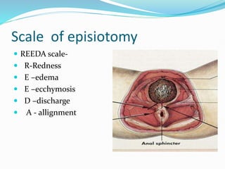 Scale of episiotomy
 REEDA scale-
 R-Redness
 E –edema
 E –ecchymosis
 D –discharge
 A - allignment
 