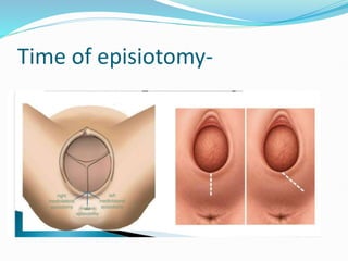Time of episiotomy-
 