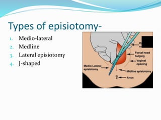 Types of episiotomy-
1. Medio-lateral
2. Medline
3. Lateral episiotomy
4. J-shaped
 