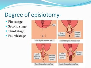 Degree of episiotomy-
 First stage
 Second stage
 Third stage
 Fourth stage
 