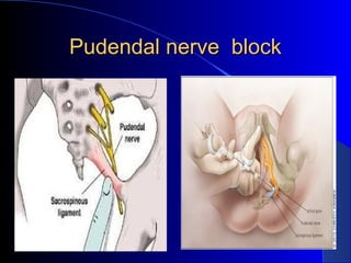 Pudendal nerve blockPudendal nerve block
.
.
 