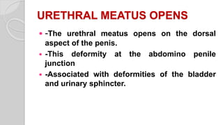 URETHRAL MEATUS OPENS
 -The urethral meatus opens on the dorsal
aspect of the penis.
 -This deformity at the abdomino penile
junction
 -Associated with deformities of the bladder
and urinary sphincter.
 
