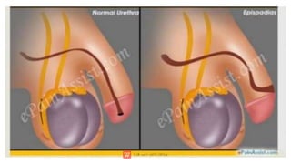 EPISPADIASIS CHN PRESENTATION.pptx