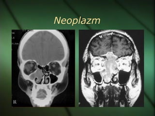 Neoplazm
 