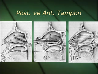 Post. ve Ant. Tampon
 