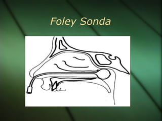 Foley Sonda
 