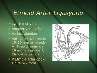 Etmoid Arter Ligasyonu
 Lynch insizyonu
 Anguler veni bağla
 Periost altından
 Ant. Lakrimal krestin
  15-20 mm arkasında
  A. Etmoid, onun da
  10 mm arkasında P.
  Etmoid arter bulunur
 P Etmoid arter optik
  sinire 5-7 mm!
 