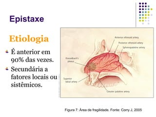É anterior em
90% das vezes.
Secundária a
fatores locais ou
sistêmicos.
Etiologia
Epistaxe
Figura 7: Área de fragilidade. Fonte: Corry J, 2005
 