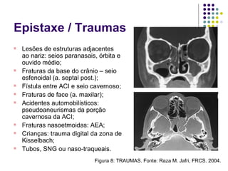 Epistaxe / Traumas
Figura 8: TRAUMAS. Fonte: Raza M. Jafri, FRCS. 2004.

Lesões de estruturas adjacentes
ao nariz: seios paranasais, órbita e
ouvido médio;

Fraturas da base do crânio – seio
esfenoidal (a. septal post.);

Fístula entre ACI e seio cavernoso;

Fraturas de face (a. maxilar);

Acidentes automobilísticos:
pseudoaneurismas da porção
cavernosa da ACI;

Fraturas nasoetmoidas: AEA;

Crianças: trauma digital da zona de
Kisselbach;

Tubos, SNG ou naso-traqueais.
 