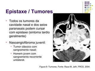 Epistaxe / Tumores
Figura 9: Tumores. Fonte: Raza M. Jafri, FRCS. 2004.

Todos os tumores da
cavidade nasal e dos seios
paranasais podem cursar
com epistaxe (sintoma tardio
geralmente)

Nasoangiofibroma juvenil:

Tumor clássico com
sangramento nasal;

Homem jovem com
sangramento recorrente
unilateral.
 