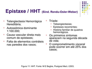 Epistaxe / HHT (Sind. Rendu-Osler-Weber)
Figura 11: HHT. Fonte: M E Begbie, Postgrad Med J 2003.

Telangiectasia Hemorrágica
Hereditária;

Autossômica dominante
1:100.000;

Causa vascular direta mais
comum de epistaxes;

Falta de elementos contráteis
nas paredes dos vasos;

Tríade:

Teleangiectasias;

Epistaxes recorrentes;

História familiar de quadros
hemorrágicos.

Os primeiros sintomas
aparecem na segunda década
de vida;

O comprometimento visceral
pode ocorrer em até 25% dos
casos;
 
