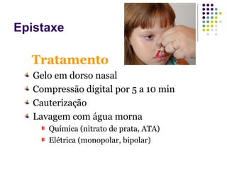 Gelo em dorso nasal
Compressão digital por 5 a 10 min
Cauterização
Lavagem com água morna
Química (nitrato de prata, ATA)
Elétrica (monopolar, bipolar)
Tratamento
Epistaxe
 