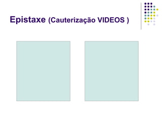 Epistaxe (Cauterização VIDEOS )
 