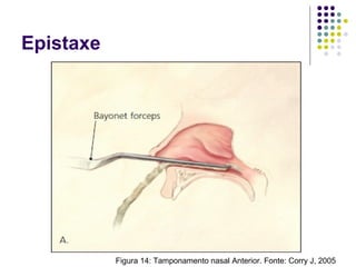 Epistaxe
Figura 14: Tamponamento nasal Anterior. Fonte: Corry J, 2005
 