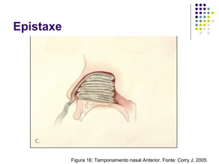 Epistaxe
Figura 16: Tamponamento nasal Anterior. Fonte: Corry J, 2005
 