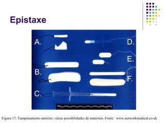 Epistaxe
Figura 17: Tamponamento anterior, várias possibilidades de materiais. Fonte: www.networkmedical.co.uk
 