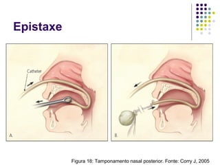 Epistaxe
Figura 18: Tamponamento nasal posterior. Fonte: Corry J, 2005
 