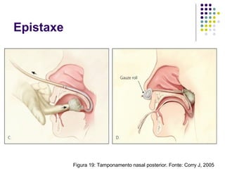 Epistaxe
Figura 19: Tamponamento nasal posterior. Fonte: Corry J, 2005
 