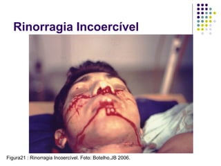 Rinorragia Incoercível
Figura21 : Rinorragia Incoercível. Foto: Botelho,JB 2006.
 
