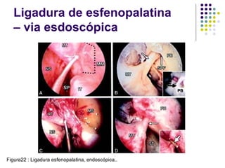 Ligadura de esfenopalatina
– via esdoscópica
Figura22 : Ligadura esfenopalatina, endoscópica..
 
