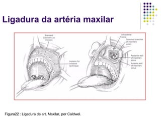 Ligadura da artéria maxilar
Figura22 : Ligadura da art. Maxilar, por Caldwel.
 