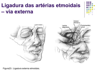 Ligadura das artérias etmoidais
– via externa
Figura23 : Ligadura externa etmoidais.
 