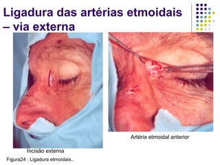 Incisão externa
Artéria etmoidal anterior
Ligadura das artérias etmoidais
– via externa
Figura24 : Ligadura etmoidais..
 