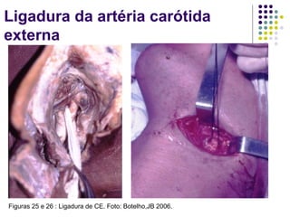 Ligadura da artéria carótida
externa
Figuras 25 e 26 : Ligadura de CE. Foto: Botelho,JB 2006.
 