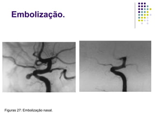 Embolização.
Figuras 27: Embolização nasal.
 