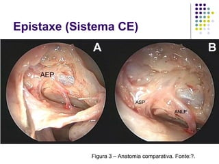 Figura 3 – Anatomia comparativa. Fonte:?.
Epistaxe (Sistema CE)
 