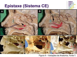 Figura 4 – Variações da Anatomia. Fonte:?.
Epistaxe (Sistema CE)
 