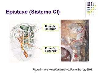 EtmoidalEtmoidal
anterioranterior
EtmoidalEtmoidal
posteriorposterior
Figura 5 – Anatomia Comparativa. Fonte: Barros, 2003.
Epistaxe (Sistema CI)
 