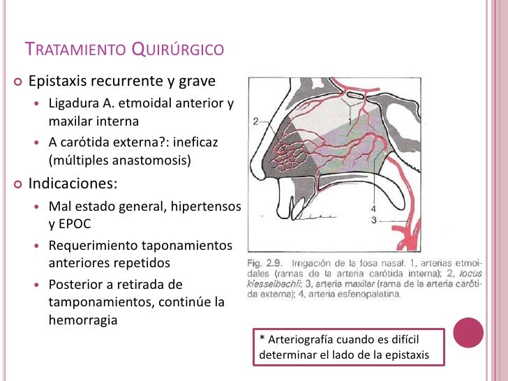 Epistaxis