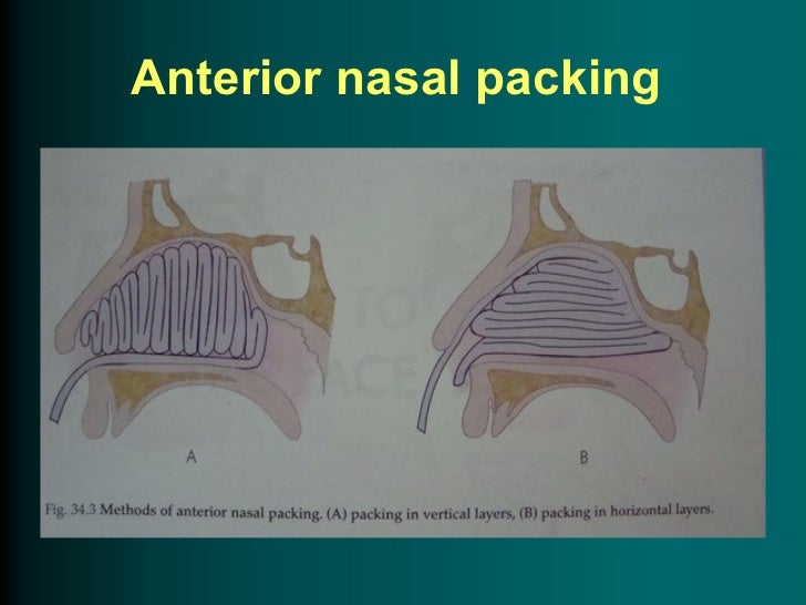 Epistaxis diagram of sinus infection 
