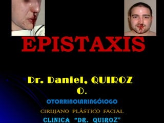 EPISTAXIS
Dr. Daniel, QUIROZ
        O.
    OTORRINOLARINGÓLOGO
  CIRUJANO PLÁSTICO FACIAL
   CLINICA “Dr. QUIrO Z”
 