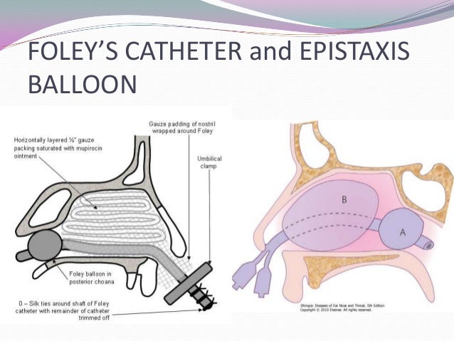 Epistaxis Epistaxis