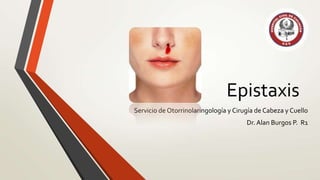 Epistaxis
Servicio de Otorrinolaringología y Cirugía de Cabeza y Cuello
Dr. Alan Burgos P. R1

 