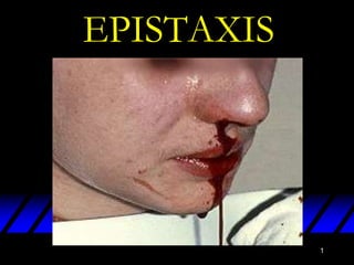 EPISTAXIS

1

 