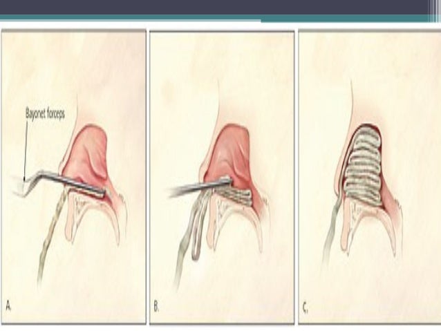 Epistaxis
