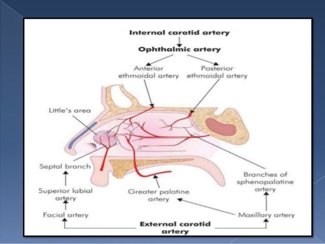 Epistaxis Epistaxis