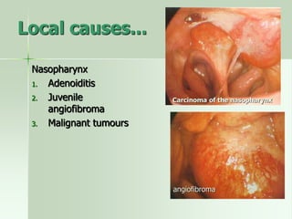 Local causes...
Nasopharynx
1. Adenoiditis
2. Juvenile
angiofibroma
3. Malignant tumours
Carcinoma of the nasopharynx
angiofibroma
 