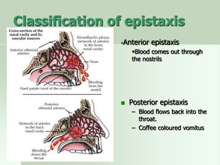 Classification of epistaxis
Anterior epistaxis
Blood comes out through
the nostrils
 Posterior epistaxis
– Blood flows back into the
throat.
– Coffee coloured vomitus
 