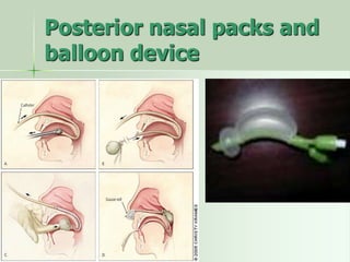 Posterior nasal packs and
balloon device
 