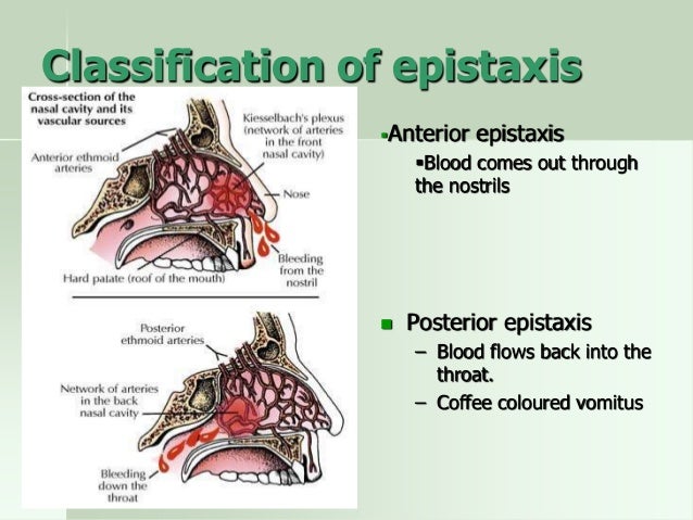 Epistaxis Epistaxis